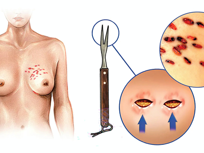 Multiple Stab Wounds Into Chest With Barbecue Fork