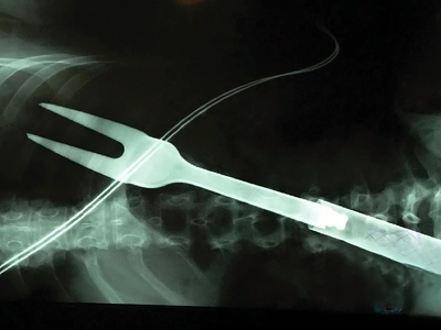 Multiple Stab Wounds Into Chest With Barbecue Fork