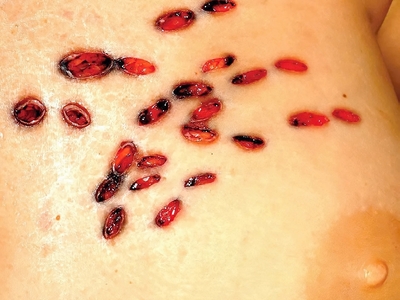 Multiple Stab Wounds Into Chest With Barbecue Fork