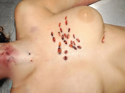 Multiple Stab Wounds Into Chest With Barbecue Fork