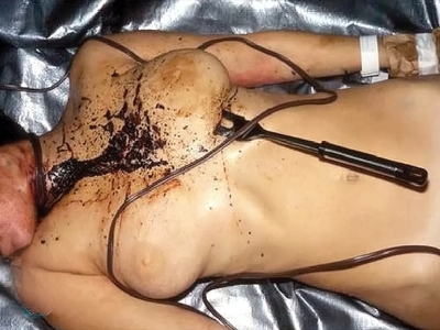 Multiple Stab Wounds Into Chest With Barbecue Fork