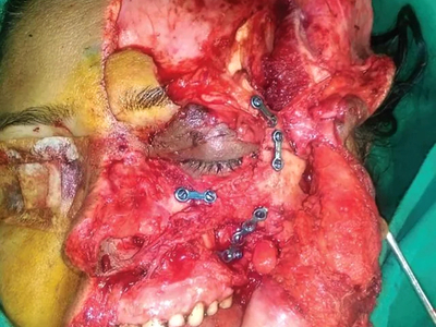 Facial avulsion