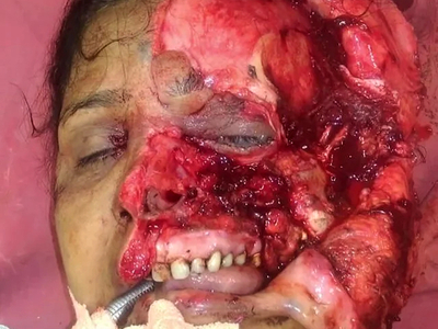 Facial avulsion