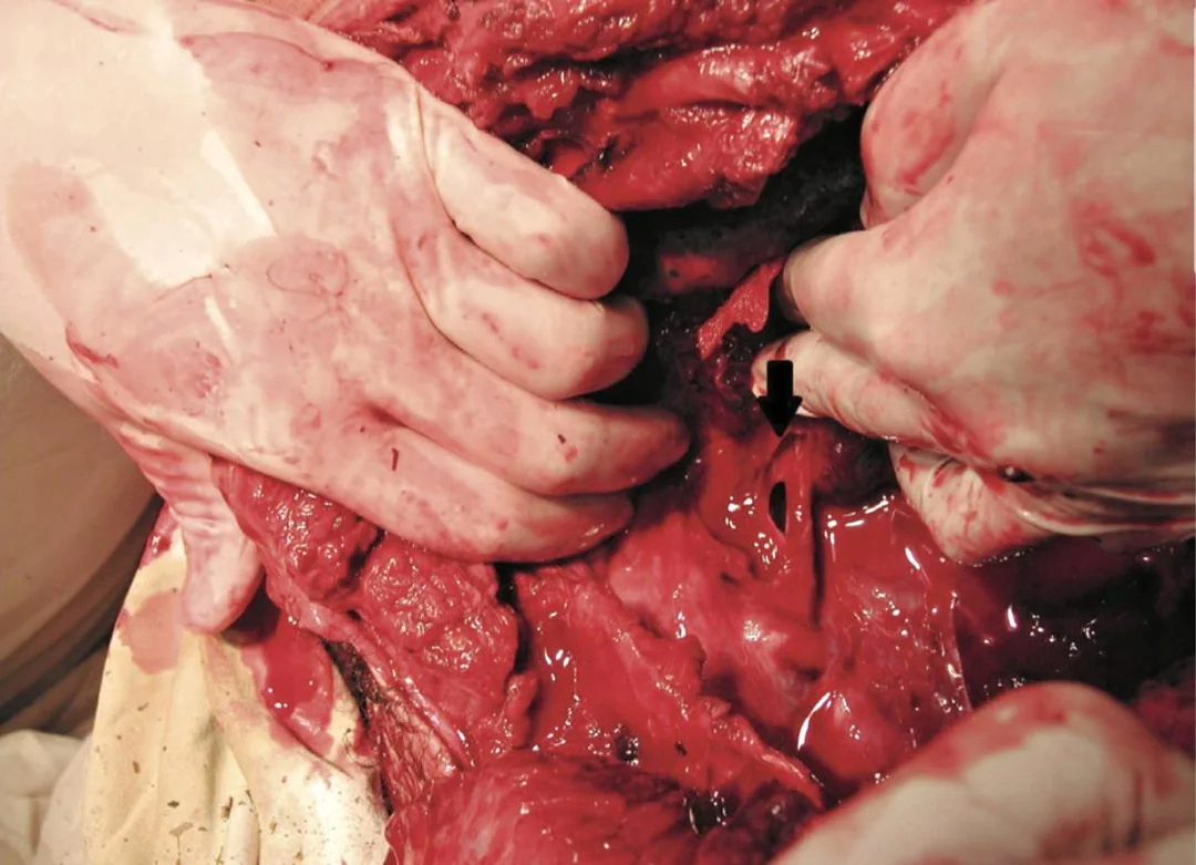 Complex thoracic impalement