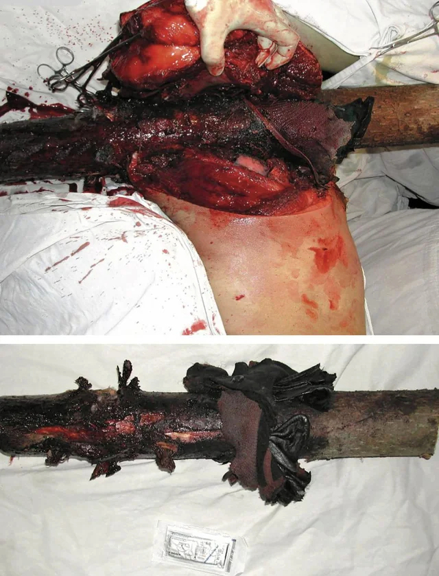 Complex thoracic impalement