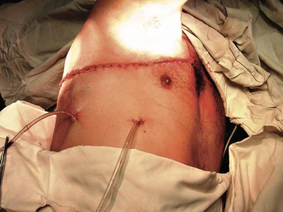 Complex thoracic impalement