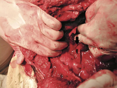 Complex thoracic impalement