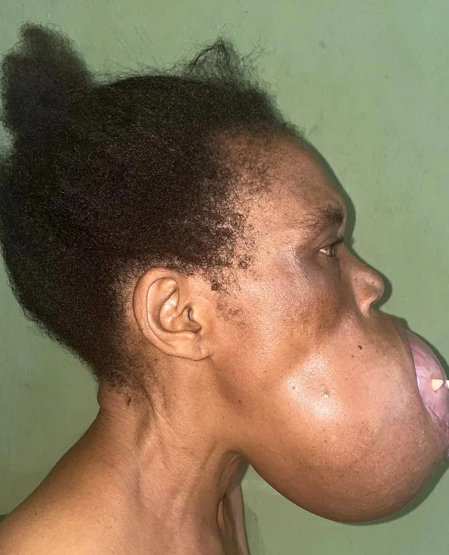 Removal of a mandibulectomy mass