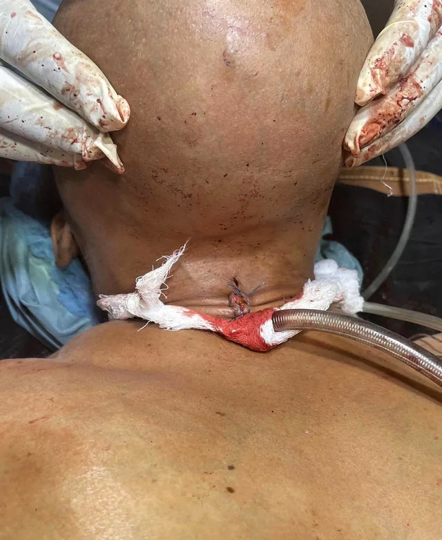 Removal of a mandibulectomy mass
