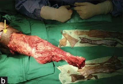 Avulsion amputation of left forearm