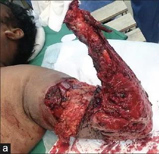 Avulsion amputation of left forearm