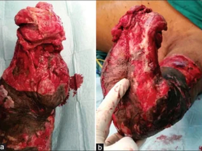 Avulsion amputation of left forearm
