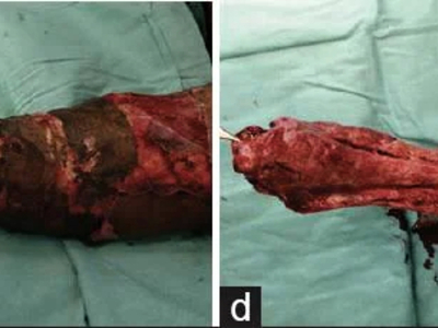 Avulsion amputation of left forearm
