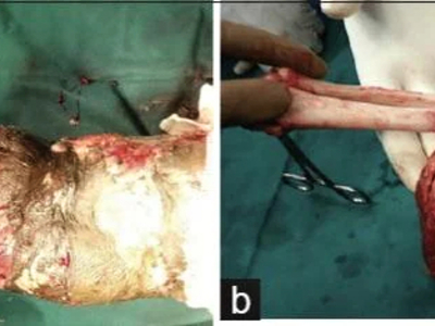 Avulsion amputation of left forearm