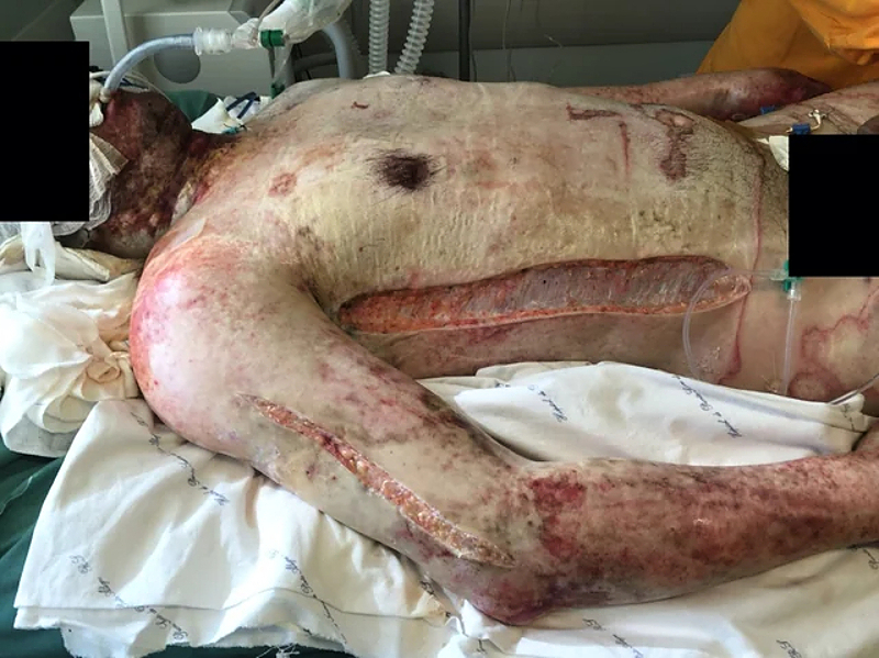Escharotomy pictures after severe burns
