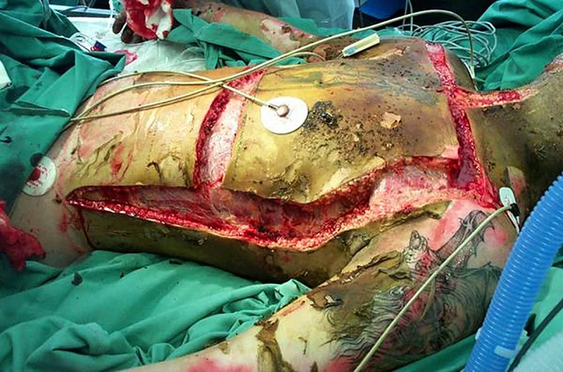 Escharotomy pictures after severe burns