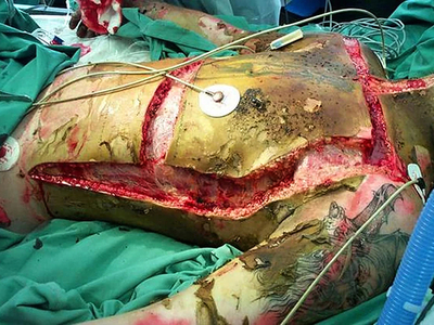 Escharotomy pictures after severe burns