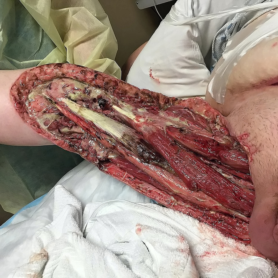 Necrotizing fasciitis of the right groin and upper inner thigh