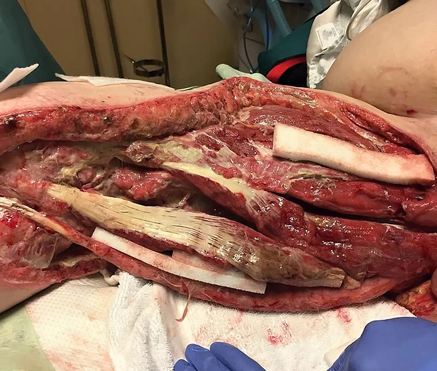 Necrotizing fasciitis of the right groin and upper inner thigh