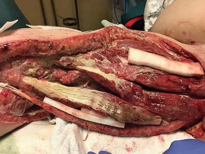 Necrotizing fasciitis of the right groin and upper inner thigh