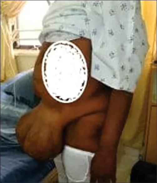 Giant pedunculated incisional hernia