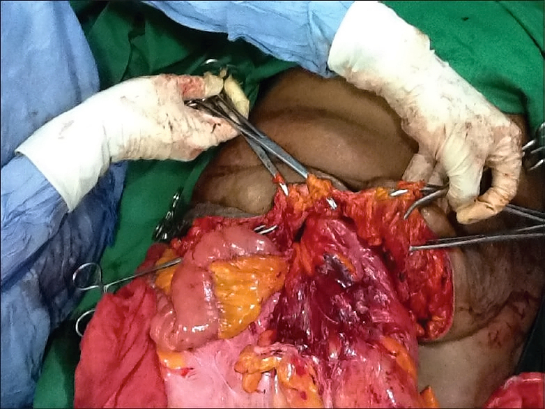 Giant pedunculated incisional hernia