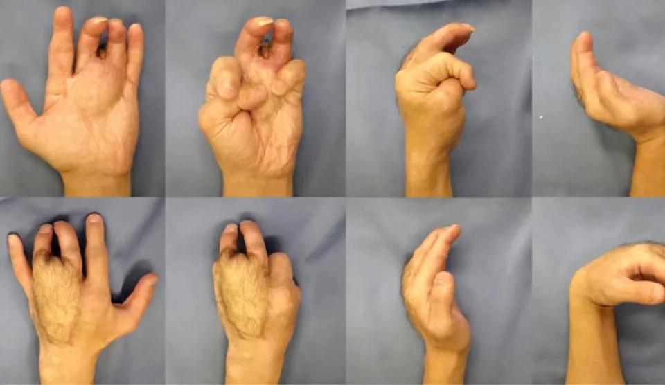 Reconstruction of hand after punching machine accident