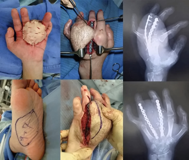 Reconstruction of hand after punching machine accident