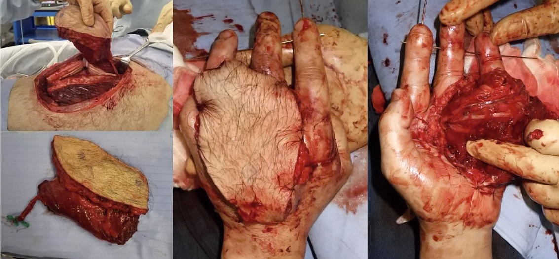 Reconstruction of hand after punching machine accident