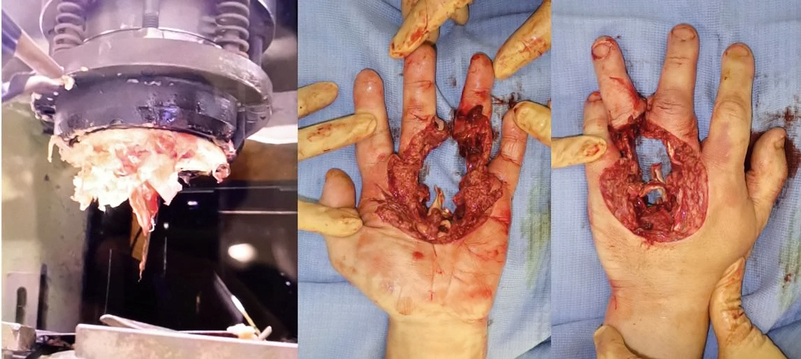 Reconstruction of hand after punching machine accident