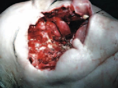 Fungal infection following tooth extraction