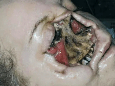 Fungal infection following tooth extraction