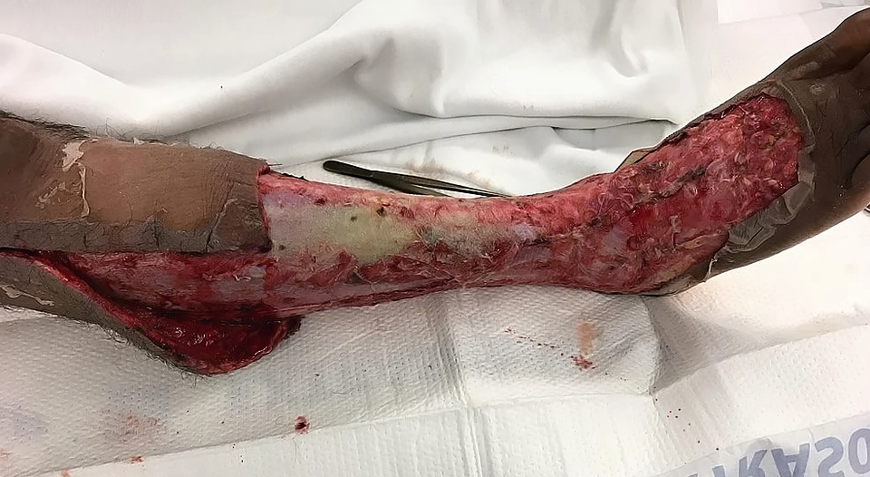 Necrotizing fasciitis of the leg