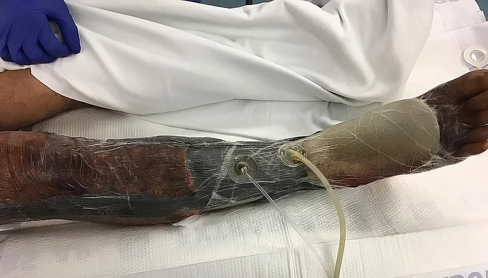 Necrotizing fasciitis of the leg