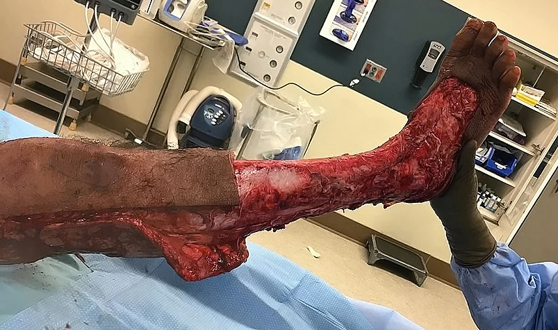 Necrotizing fasciitis of the leg