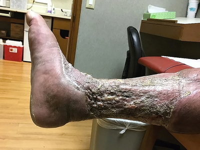 Necrotizing fasciitis of the leg