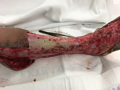 Necrotizing fasciitis of the leg