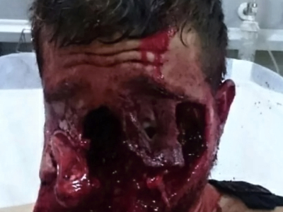 Various injuries and illnesses #IV