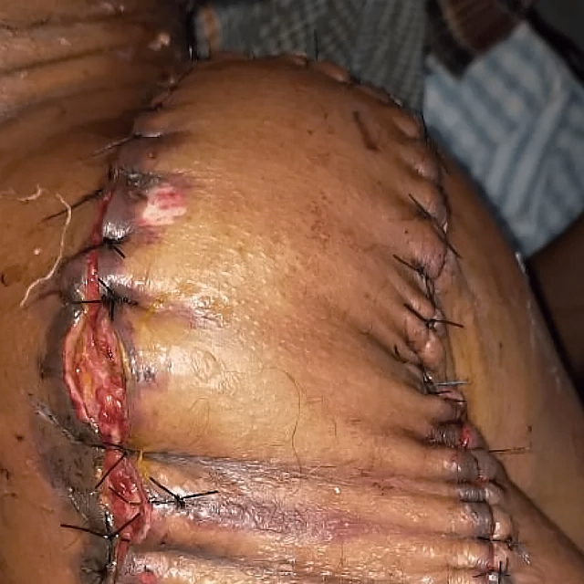 Extraskeletal Ewing sarcoma