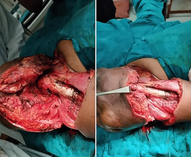 Extraskeletal Ewing sarcoma