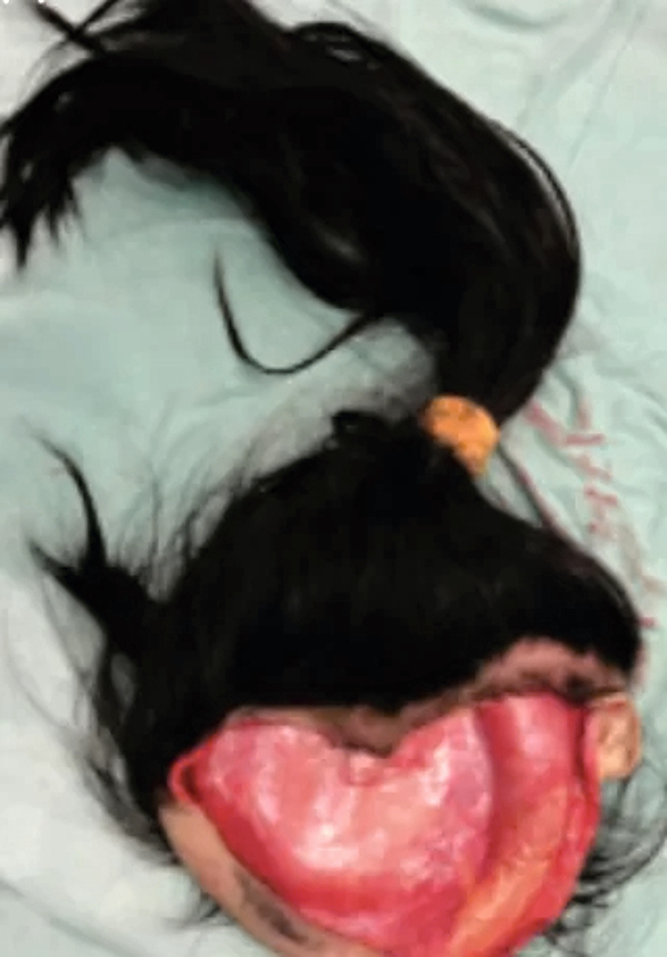 Repair of total scalp avulsion