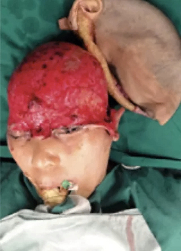 Repair of total scalp avulsion
