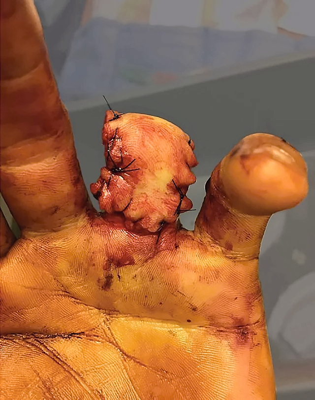 Ring avulsion and degloving injury