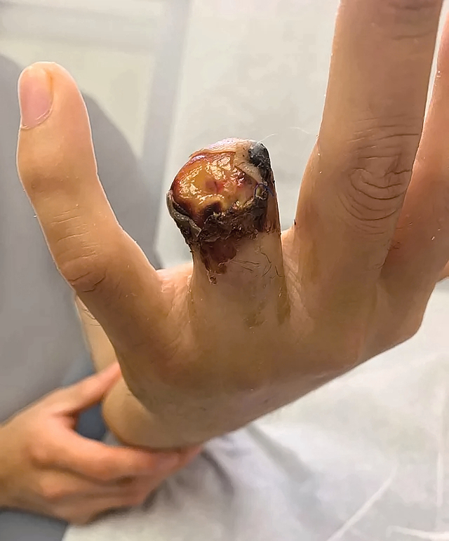Ring avulsion and degloving injury