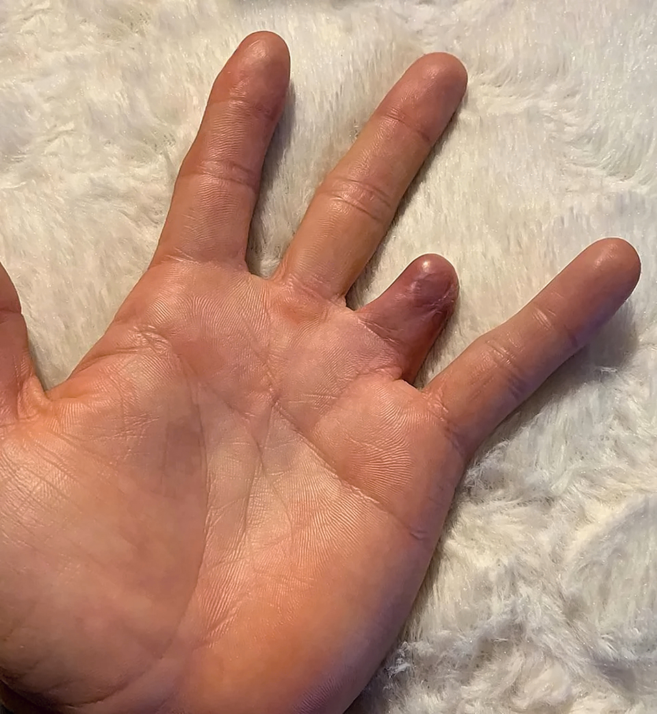 Ring avulsion and degloving injury