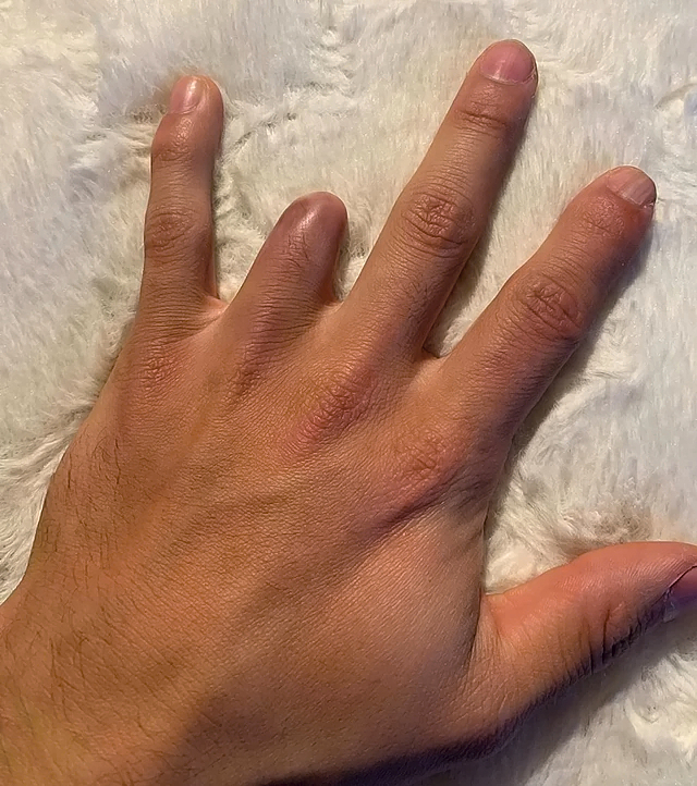 Ring avulsion and degloving injury