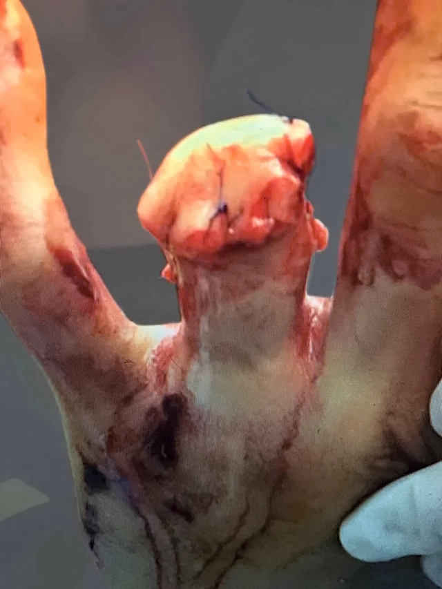 Ring avulsion and degloving injury