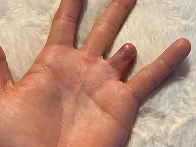 Ring avulsion and degloving injury