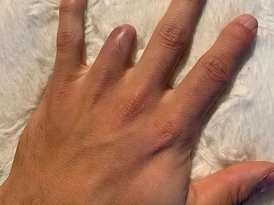 Ring avulsion and degloving injury