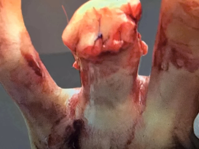 Ring avulsion and degloving injury